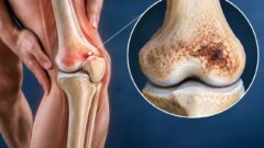Femur Alt Uç Aseptik Nekrozu nedir? İşte merak edilenler