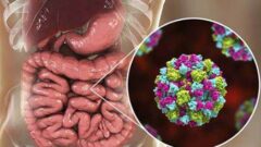 Norovirüs hakkında merak edilenler: nedir?